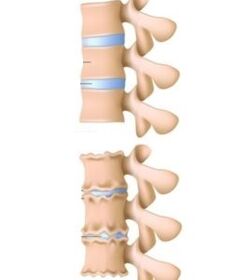 As causas da osteocondrose