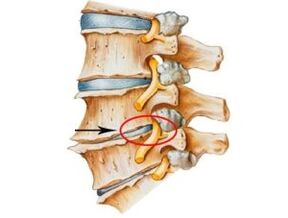 Sinais e sintomas de osteocondrose