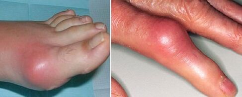 aparecimento de articulações com artrite