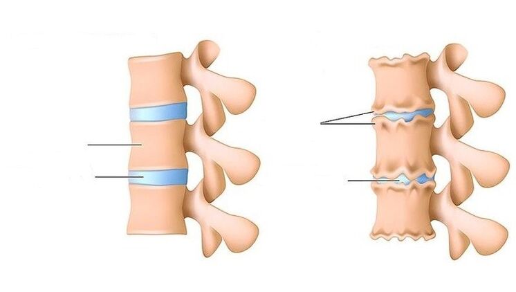 coluna saudável e coluna afetada por osteocondrose