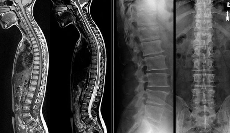 Imagens de raios-x e ressonância magnética para osteocondrose