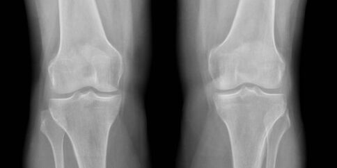 radiografia de osteoartrite do joelho