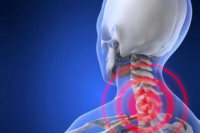 Dor de tiro no pescoço - um sintoma precoce de osteocondrose cervical