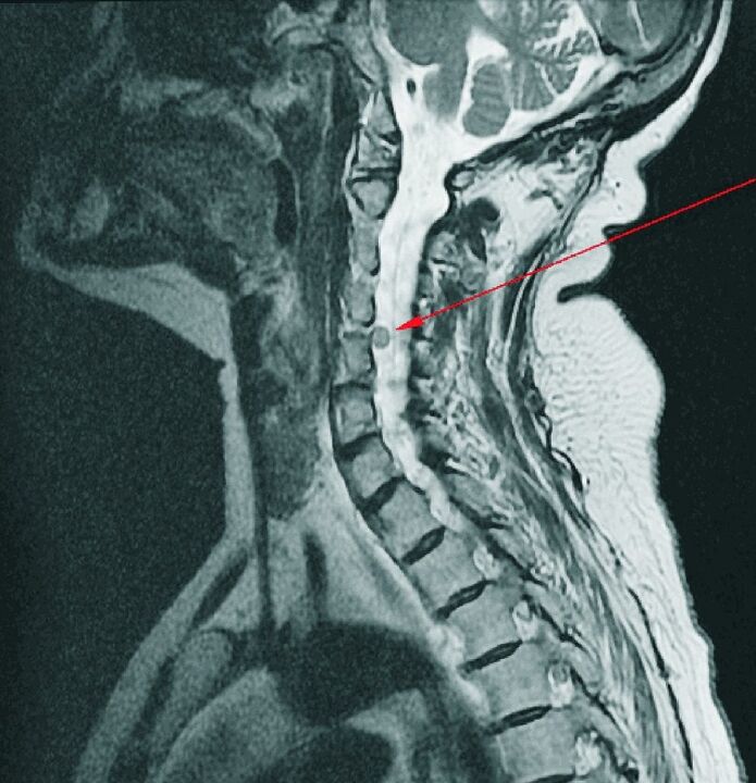 Hérnia intervertebral da coluna cervical na ressonância magnética