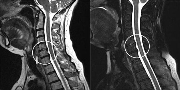 RM da coluna cervical com sinais de osteocondrose