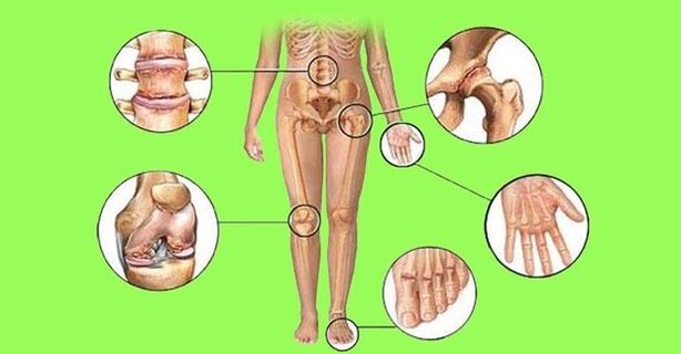 articulações afetadas por artrite e artrose