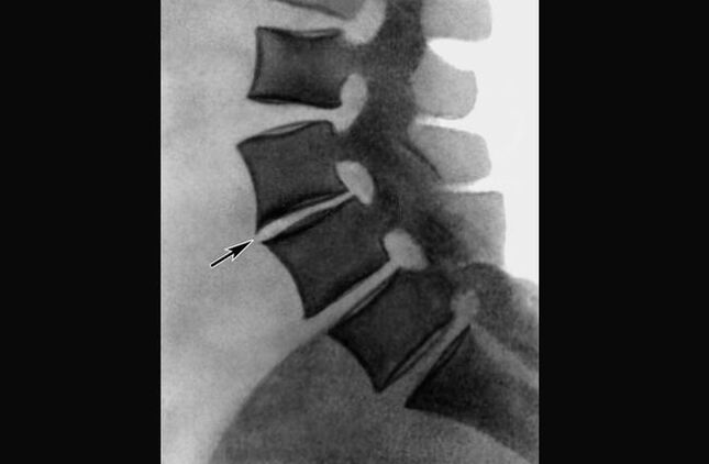 Manifestações de osteocondrose da coluna torácica na radiografia