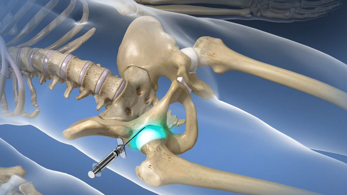 Bloqueio intra-articular para eliminar a dor aguda na coxartrose