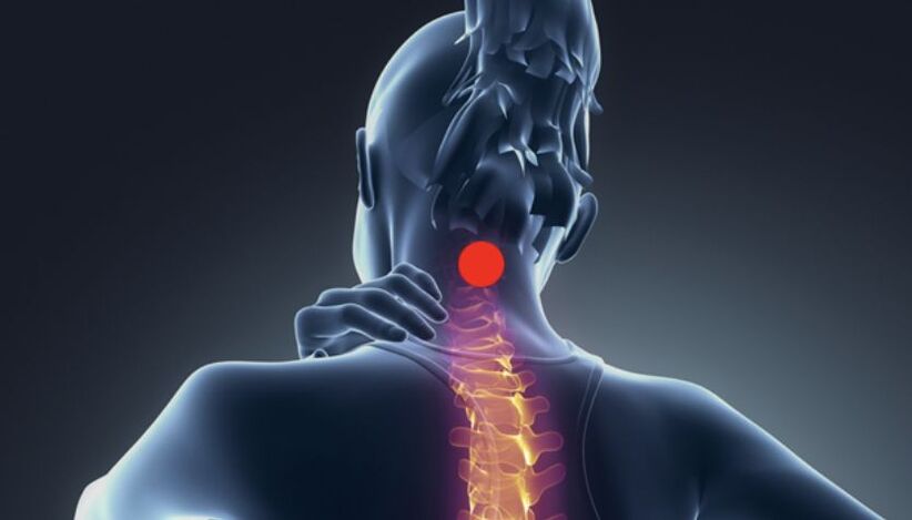 sintomas de osteocondrose cervical